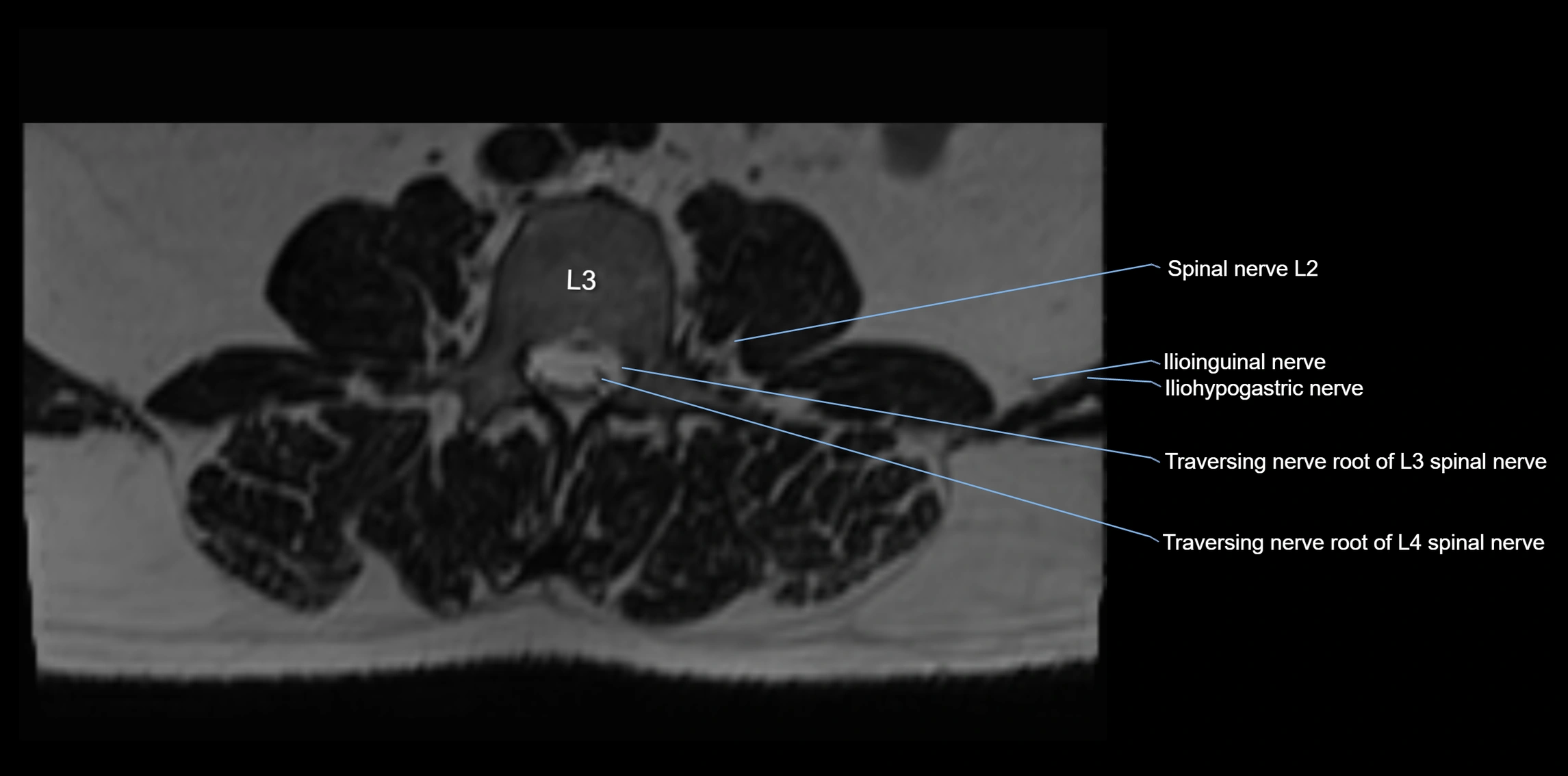 MR lumbosacral plexus axial cross sectional anatomy 3T  radiology  image-img-1008001-00020.webp